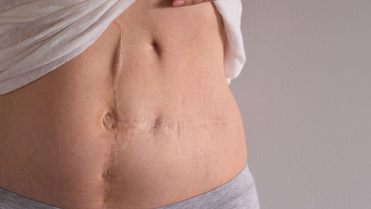 Best Hysterectomy Surgery in Indore